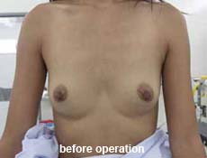 plastic-surgery-breast-augmentation 